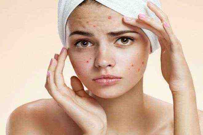 best home remedies for pimples dark spot