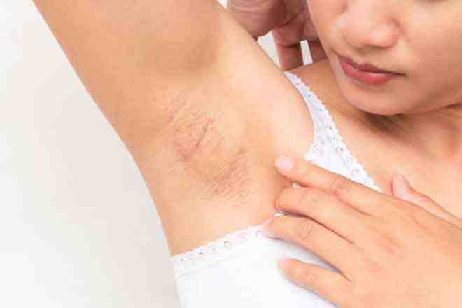 Do not make these mistakes while removing underarm hair